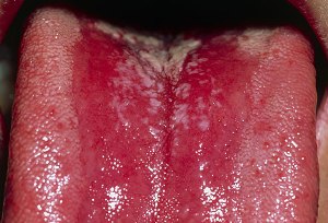 candida overgrowth symptoms-oral thrush